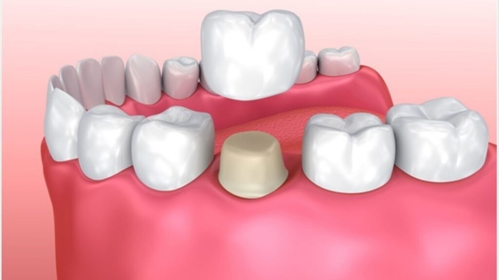 Avoiding Unnecessary Crowns: Is It Always Necessary to Grind Down a Tooth?
