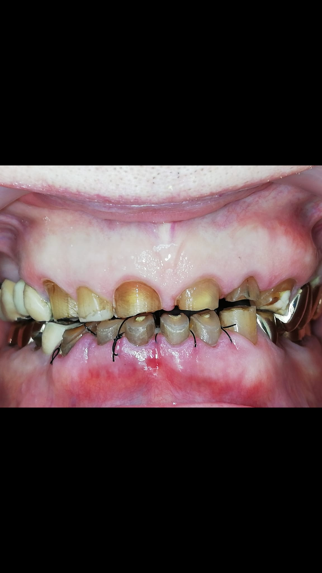 Before treatment 1