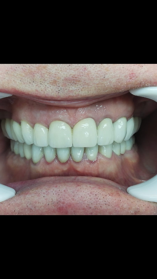 After treatment 1