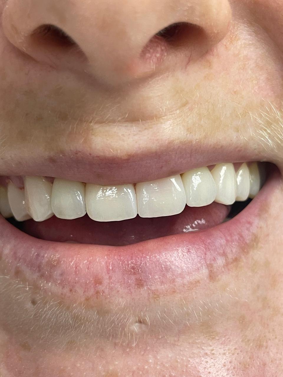 After treatment 2