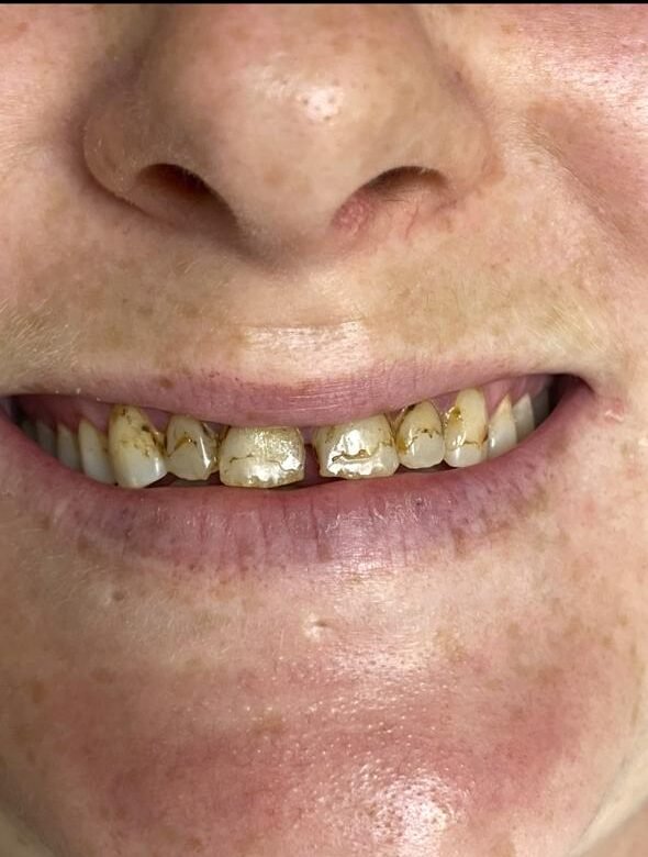 Before treatment 2